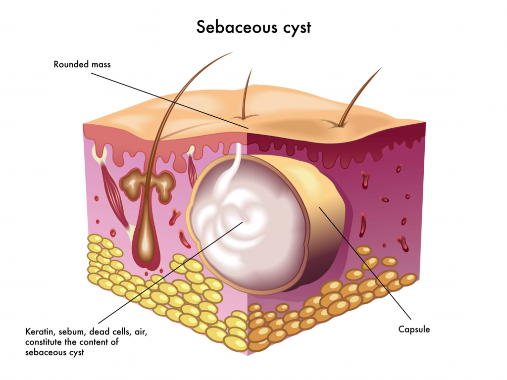 what-are-cysts